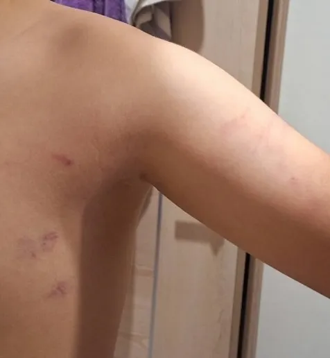 家長說，事件第一天孩子返家後，脫下上衣讓他們看到他身上的傷痕。家長提供