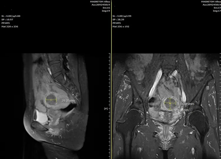 吳姓患者術後回診進行MRI檢查，肌瘤經無創海芙治療消融後，逐漸被周圍正常組織吸收縮。童綜合提供