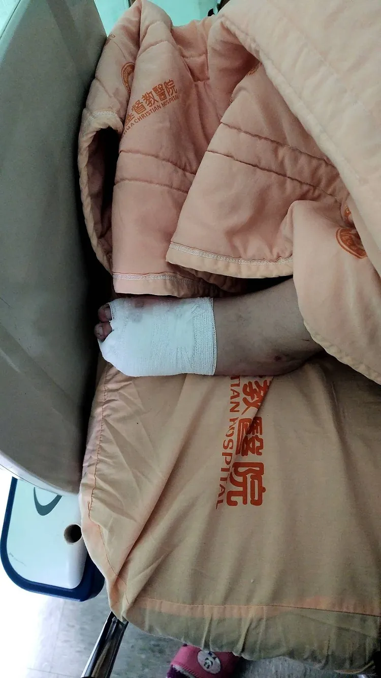 少女左腳第四趾被撞斷。翻攝「爆料公社」