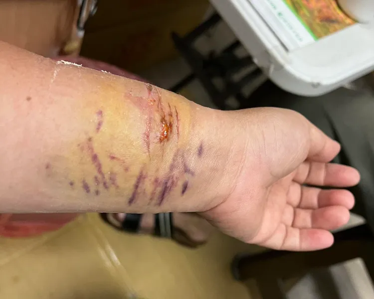 王美惠左手腕受傷掛彩。翻攝王定宇臉書