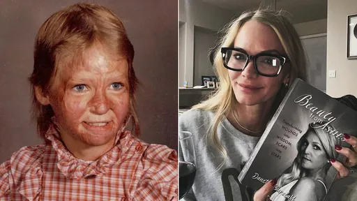 10歲女孩被氣爆毀容 花38年成為選美皇后