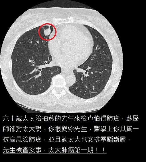陪老菸槍尪做檢查 突被醫告知「妳也該照!」婦竟真罹癌