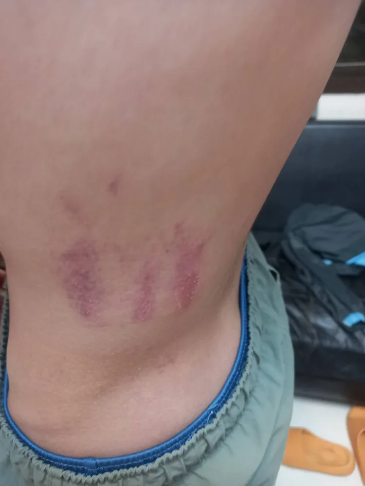 王同學被踢到腰部一大片紅腫瘀青。投訴人提供