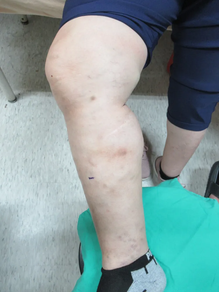 曾婦就診時靜脈曲張已趨近第5期，搔癢、腫脹，腿部也很不美觀，中港澄清提供