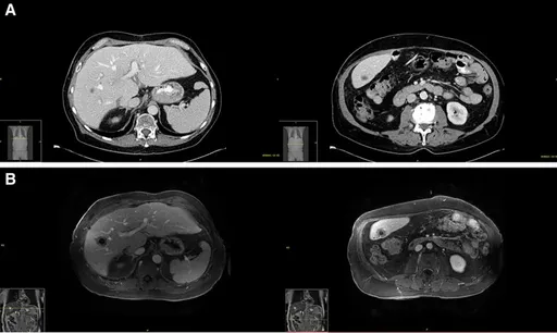 接受肝臟器捐竟爆發「轉移性癌症」身亡 醫院證實:源頭來自捐贈者