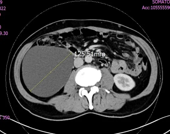 治療前12.5公分腫瘤。奇美醫院提供