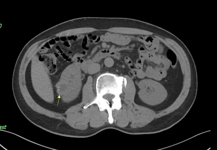 治療後腫瘤萎縮、症狀消失。奇美醫院提供