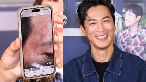 男星拍戲臉突發癢腫脹 紅疹爬滿全臉超嚇人