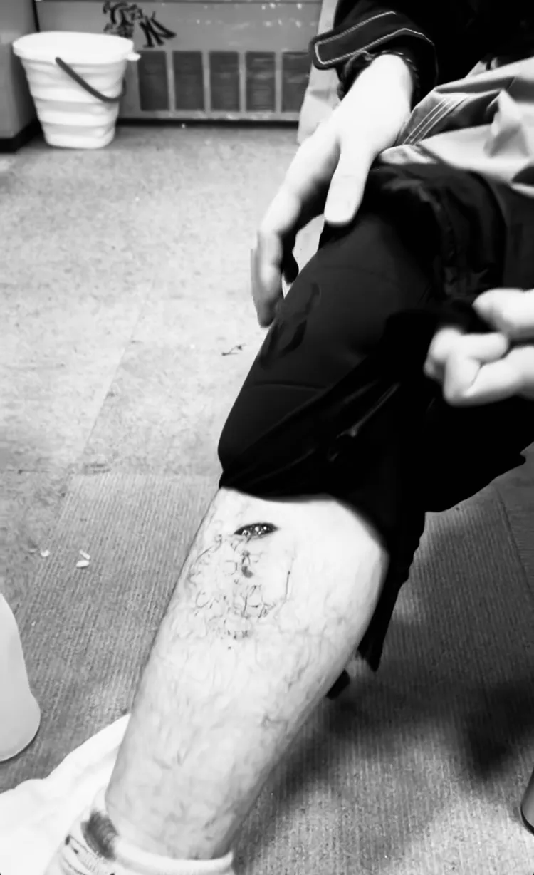 周湯豪脛骨遭割傷，深可見骨，相當驚悚。圖／翻攝IG黑白處理