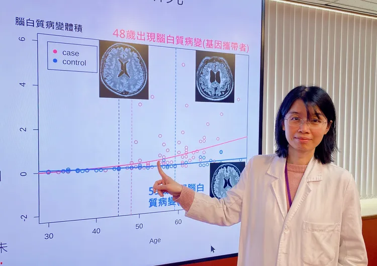 中榮神經內科醫師董欣指出，R544C帶因者從48歲開始，腦部白質病變風險就會快速增加。中榮提供