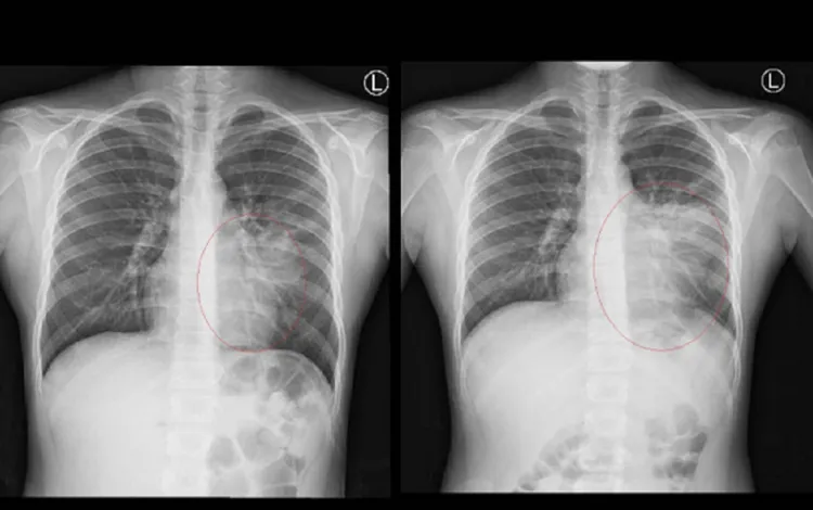 女童住院時X光片(左)，接受抗生素治療3天後，X光片反白範圍更大(右)。彰化醫院提供