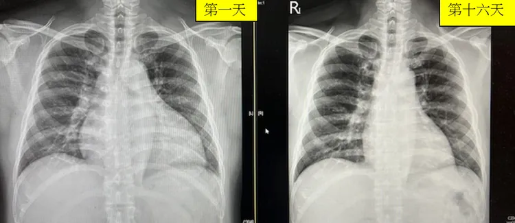 病患胸部X光照片。臺北市立聯合醫院陽明院區心臟內科主任曾梓維提供