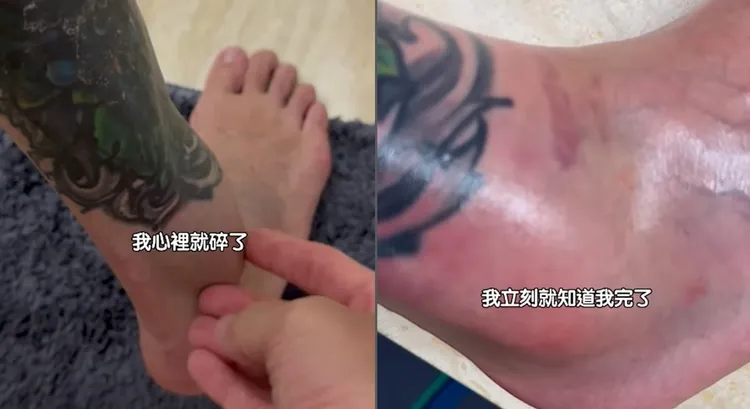 王陽明扭傷，韌帶撕裂、兩處骨裂。翻攝王陽明IG