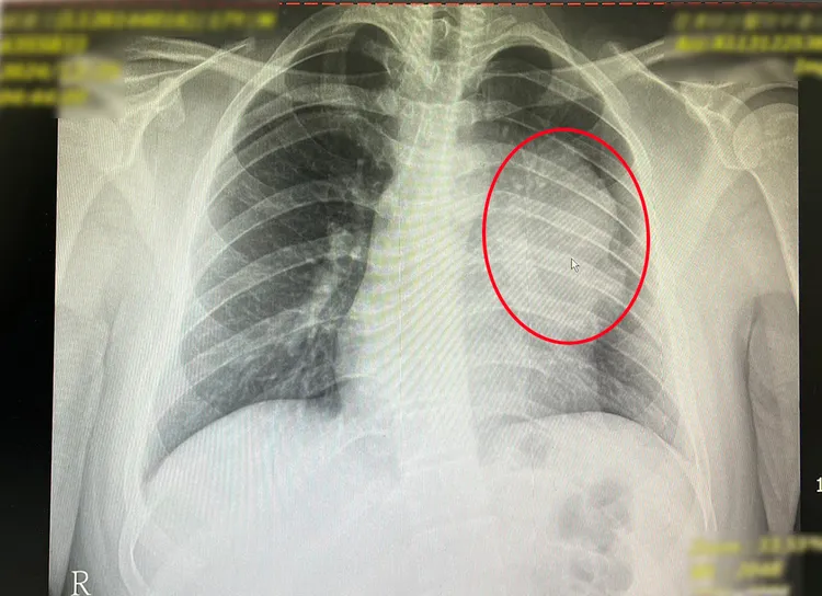 少年胸腔有1顆12公分大的縱膈腔精細胞瘤。中港澄清提供