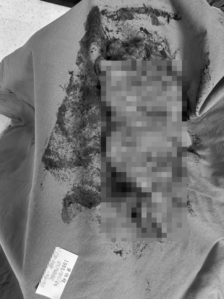 超哥罹患的是「大腸原位癌0期」。超哥提供