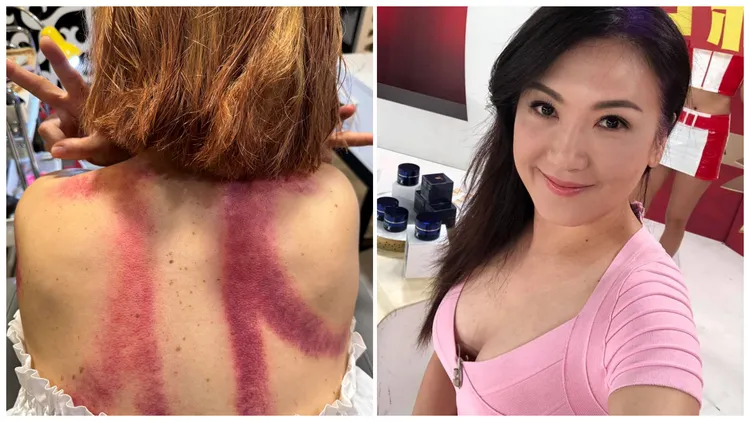 姚黛瑋15日登場「民歌五十演唱會」，在前日西洋情人節這天卻曬出裸背照，驚曝背上的6道「刮痕」，翻攝自姚黛瑋臉書