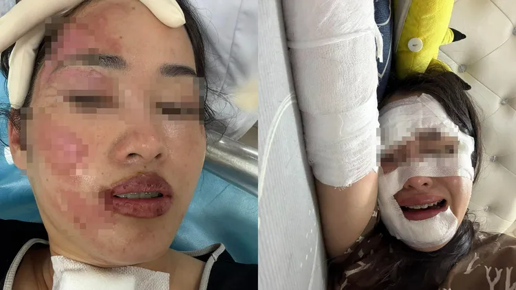 女壽星半邊臉燒燙傷。翻攝臉書