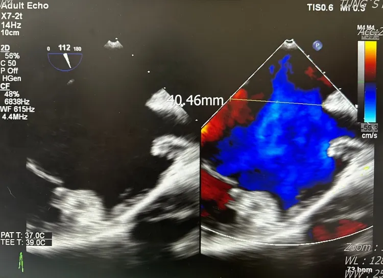 心臟超音波檢查影像發現是先天性心房中隔缺損(缺損直徑已達4公分)。童醫院提供