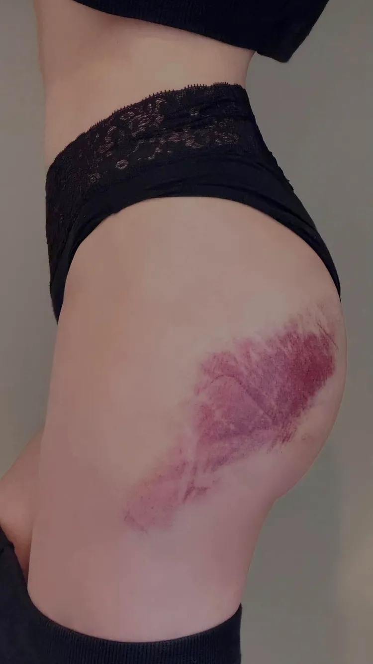 鮪魚滑雪跌倒摔出大片瘀青。翻攝鮪魚臉書