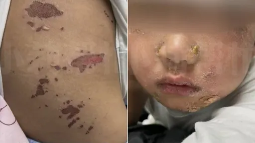 3歲童吃火鍋燙傷嘴角 3天後竟全身多處潰爛
