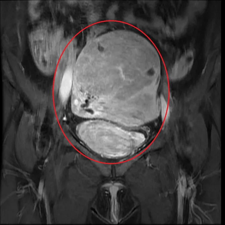 子宮肌腺症病灶檢查影像圖片。亞大附醫提供