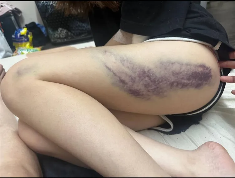 女員工大腿有大片瘀青。民眾提供