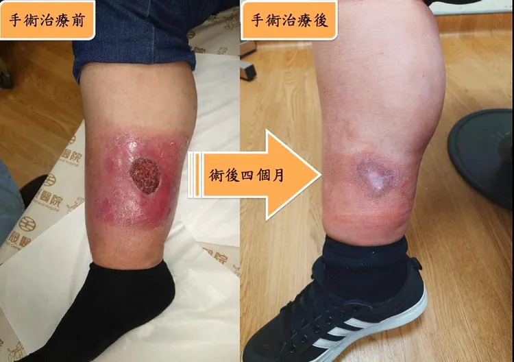 術前術後。中壢天晟醫院提供