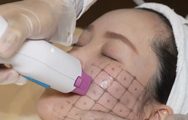 鳳凰電波施打圖。資料照