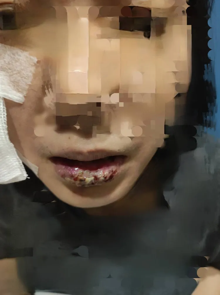 康小姐因車禍有3顆牙齒斷裂，3顆受損搖晃，嘴唇受傷。讀者提供