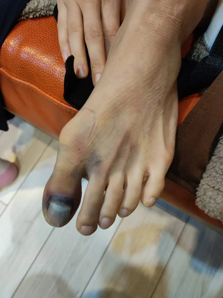 重達10公斤的電池因握把斷裂，砸在康小姐的左腳，導致大姆趾黑青骨折。讀者提供