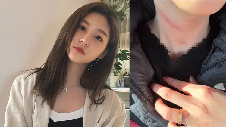 自稱金賽綸的前男友對媒體公布她脖子傷痕照。翻攝金賽綸IG、THE FACT