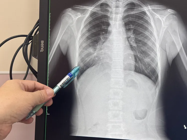 余秋霖說，有學童染黴漿菌肺炎導致肺有一片白。大甲李綜合醫院提供