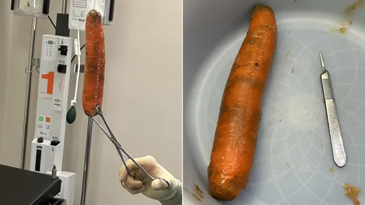 20cm紅蘿蔔被他用來「爆菊」 醫師急手術:我們把它救出來了
