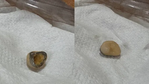 鳳梨酥加料一咬竟掉出假牙 民眾檢舉南市衛生局要查 業者說話了