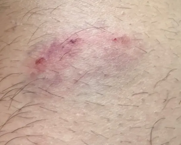 隔著警察制服，仍被黑狗咬出破皮傷口。翻攝畫面