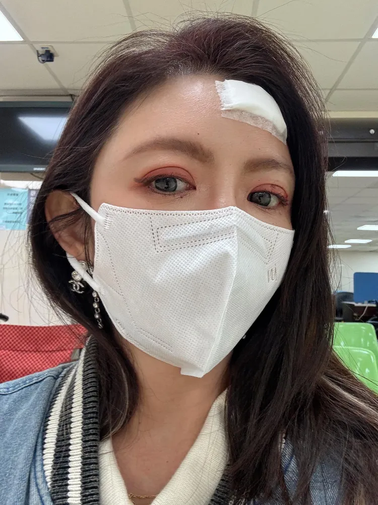 李芳瑜頭縫2針。翻攝自李芳瑜FB