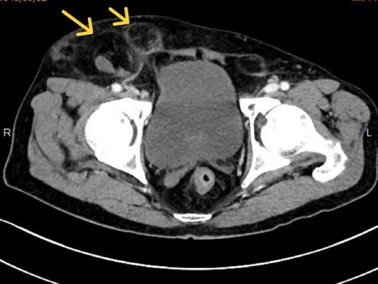 從電腦斷層影像可見兩個大小不一的疝氣囊(箭頭處)。高醫岡山醫院提供