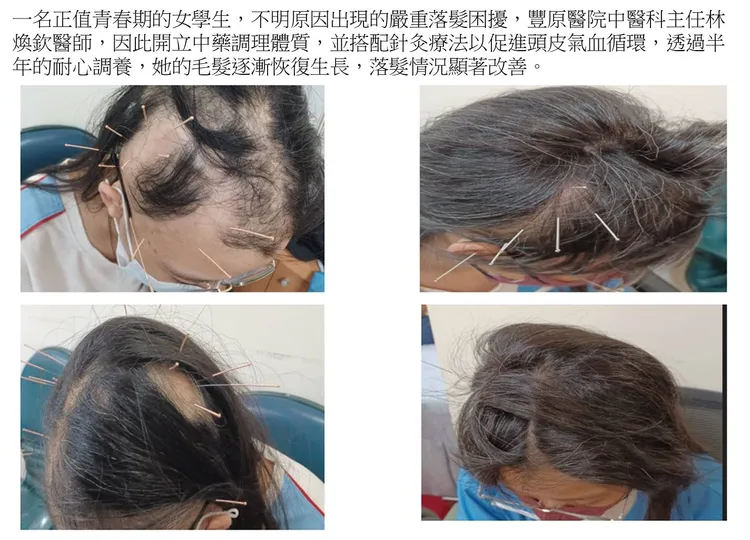 不明原因嚴重掉髮的高中女生，經中藥及針灸治療後，逐漸長回茂密頭髮。豐原醫院提供