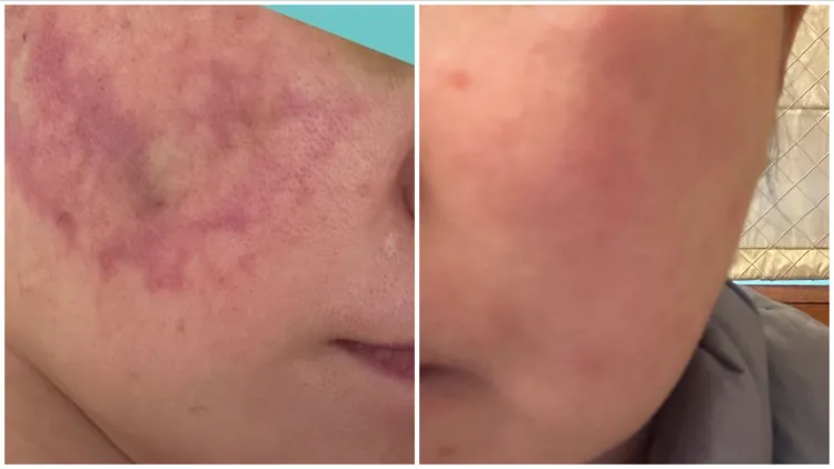 前去韓國施打醫美結果造成皮膚循環不良之案例。薛博仁提供