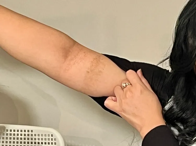 高慧君的疤痕非常明顯。莊宗達攝