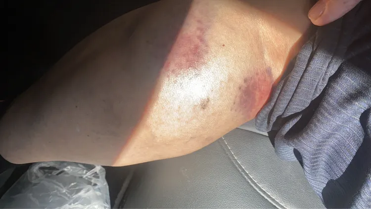 林木村被打到身體多處瘀傷。翻攝「彰化縣媒體記者協會」臉書