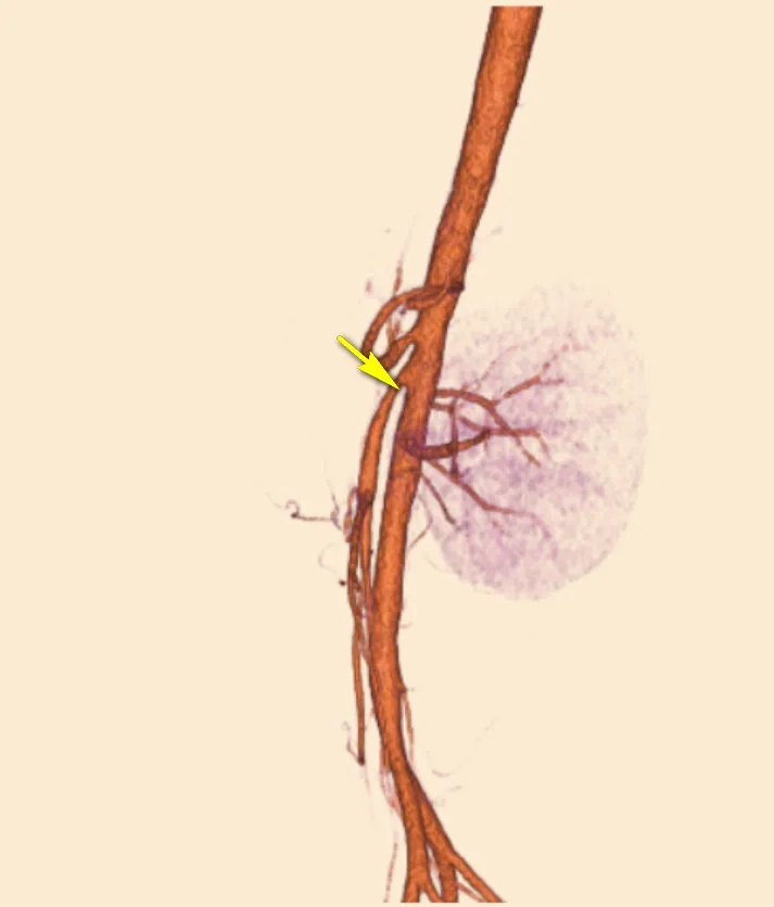 黃色箭頭所指處即為主動脈與上腸繫膜動脈夾住的十二指腸。院方提供