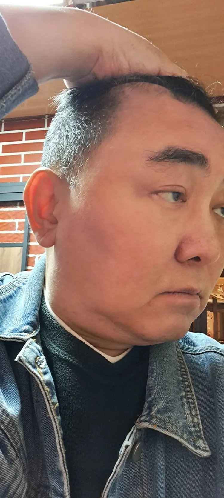 徐亨秀出腦部開刀處。翻攝徐亨臉書