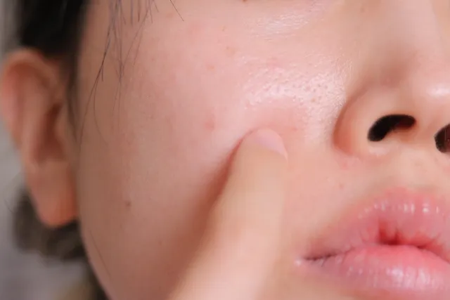 毛孔粗大、痘痘肌，泛紅的酒糟肌，沒上妝時讓皮膚看起來花花的十分沒質感。