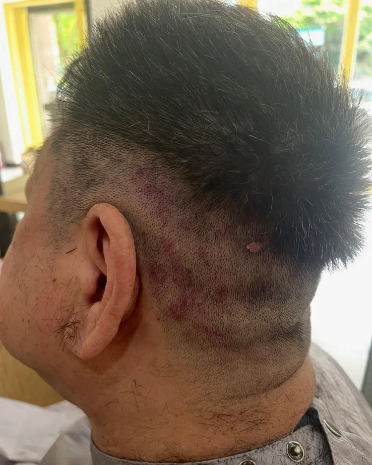 孫德榮頭皮佈滿紅斑。翻攝孫德榮臉書
