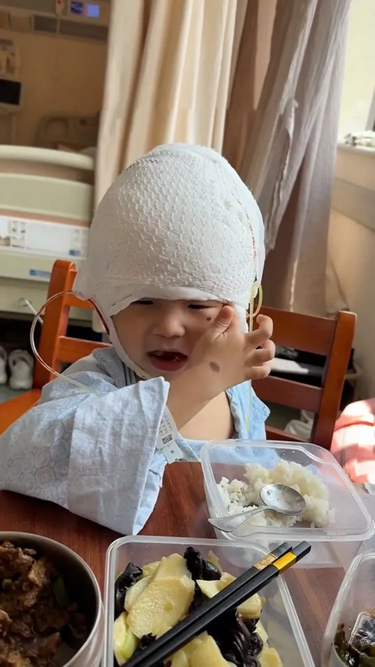 琪寶治療了5個月，頭部兩側巨痣已被移除。翻攝微博