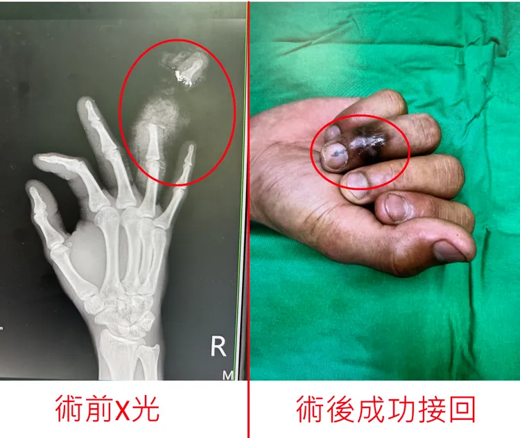 術前及術後。院方提供