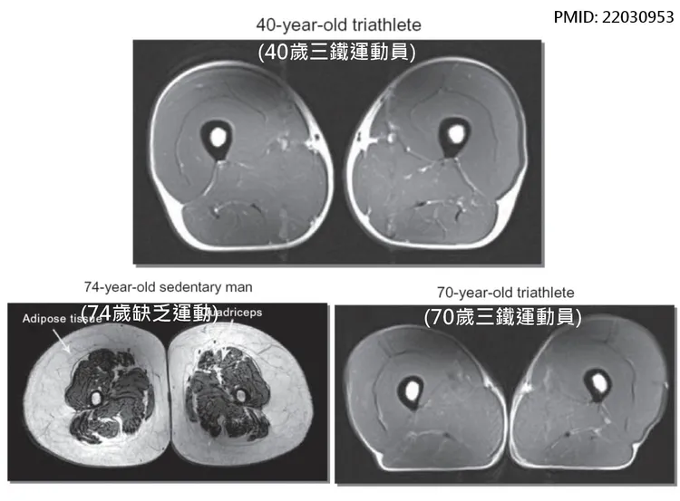 醫師曝光三張大腿部位的核磁共振影像，提醒民眾持續保持運動。翻攝自蔡明劼醫師臉書
