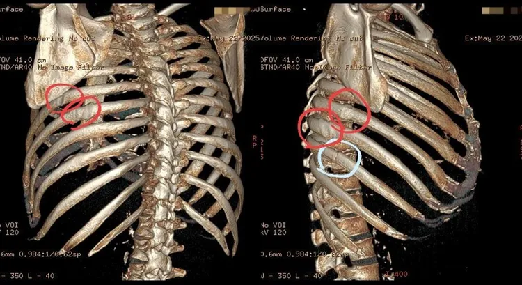 蘇一峰分享影像圖，紅圈是之前斷裂，白色是最近斷裂的肋骨。翻攝蘇一峰臉書