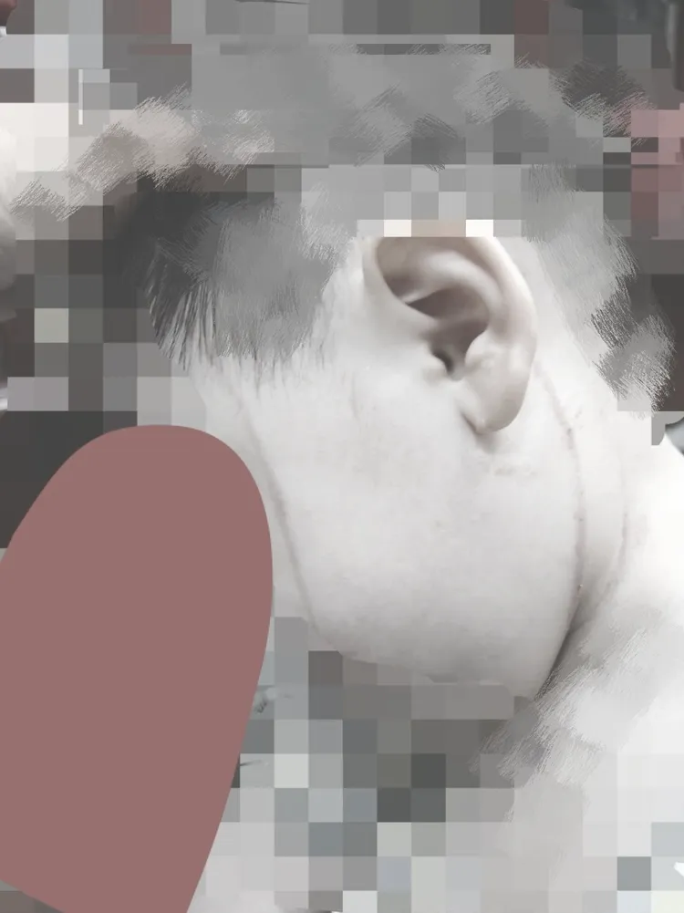 男童臉頸部被托育員抓傷。家長提供